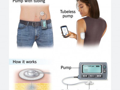 Help Zuri get an Insulin Pump