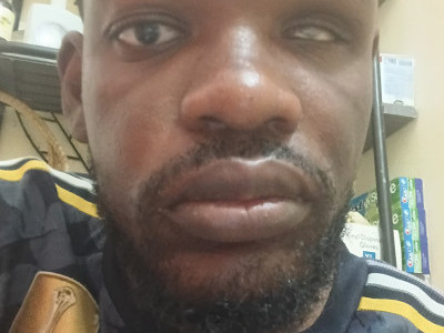Help with medical treatment for my eye