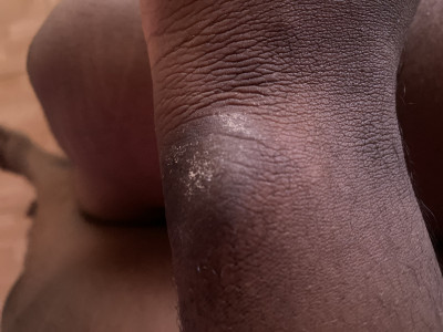 Psoriasis Treatment