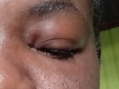 Allergy medicine (Epi-pen)