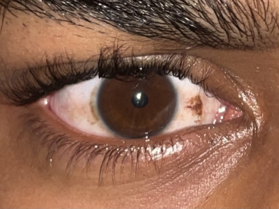 Nevus Removal Treatment