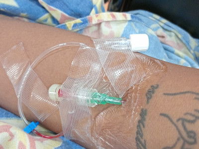 Ovarian cyst surgery